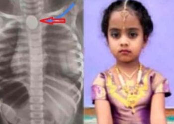 5  ರೂ. ನಾಣ್ಯ ನುಂಗಿದ ಮಗು ಸಾವು, ಚಿಕಿತ್ಸೆಗೆ ಸ್ಪಂದಿಸದೆ ಪ್ರಾಣ ಬಿಟ್ಟ ಖುಷಿ