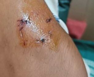 ನಕಲು ಮಾಡಿದ ವಿದ್ಯಾರ್ಥಿಯ ಕೈಗೆ ಕಚ್ಚಿದ ಉಪನ್ಯಾಸಕ