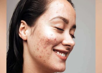 ಮೊಡವೆ ಮುಕ್ತ  ತ್ವಚೆಗೆ ಇಲ್ಲಿದೆ ನೈಸರ್ಗಿಕ ಪರಿಹಾರ