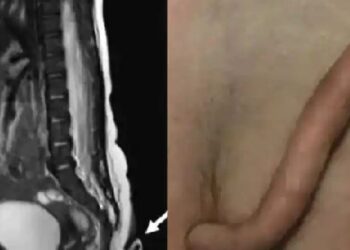 ಹುಟ್ಟುತ್ತಲೇ ಹನುಮನಂತೆ ಬಾಲ ಹೊಂದಿದ ಮಗು, ಜನ ಅಚ್ಚರಿ