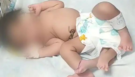 ನಾಲ್ಕು ಕಾಲಿನ ಮಗು ಜನನ, ಮತ್ತೊಂದು ಅಚ್ಚರಿಗೆ ಸಾಕ್ಷಿಯಾದ ವೈದ್ಯಲೋಕ