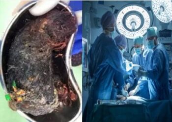 ಹೊಟ್ಟೆಯಲ್ಲಿ ಪತ್ತೆಯಾಯ್ತು ಬರೋಬ್ಬರಿ 1 ಕೆಜಿ ಕೂದಲು!,ಬಾಲಕಿಗೆ ಕೂದಲು ತಿನ್ನುವ ಅಭ್ಯಾಸವಿತ್ತೇ?ವೈದ್ಯರು ಏನು ಹೇಳಿದ್ರು?